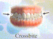 overbite