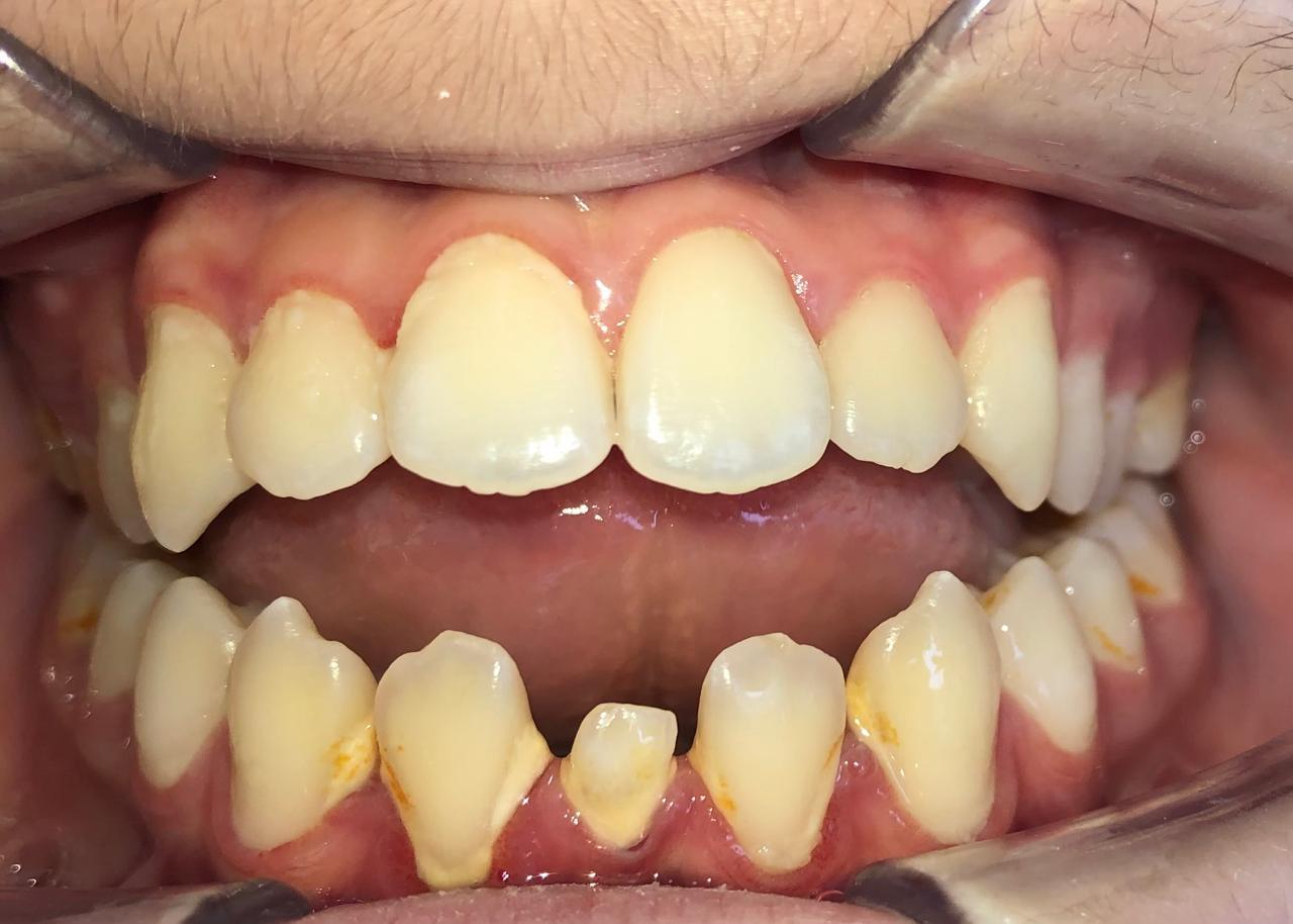 open bite