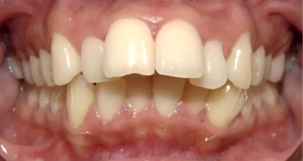 overbite