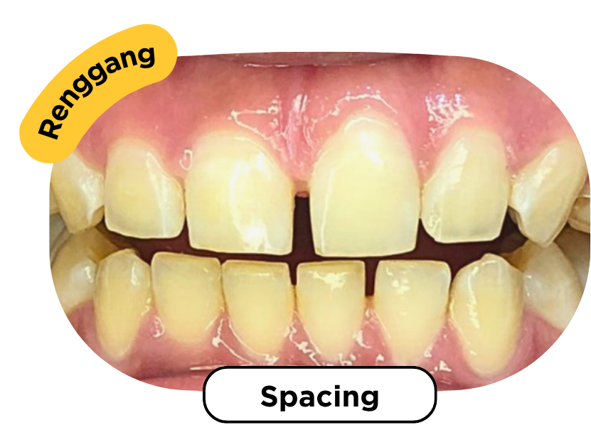 Spacing