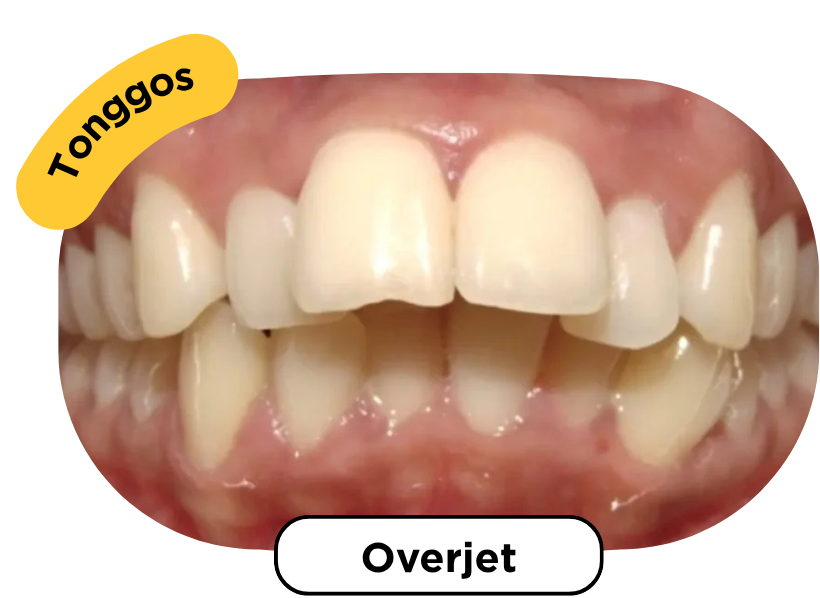 Overjet