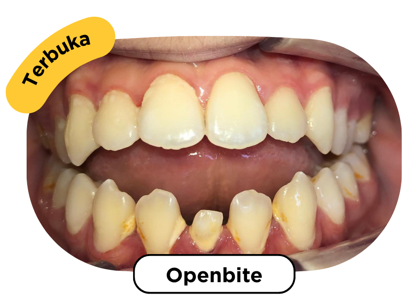 Openbite