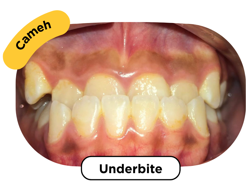 Underbite