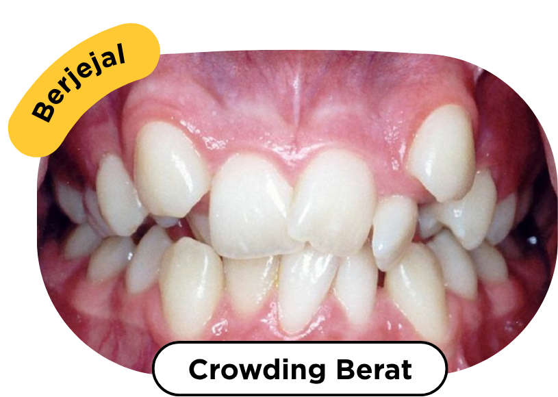 Crowding