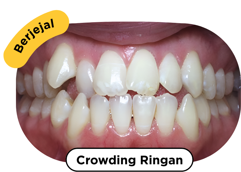 Crowdingringan
