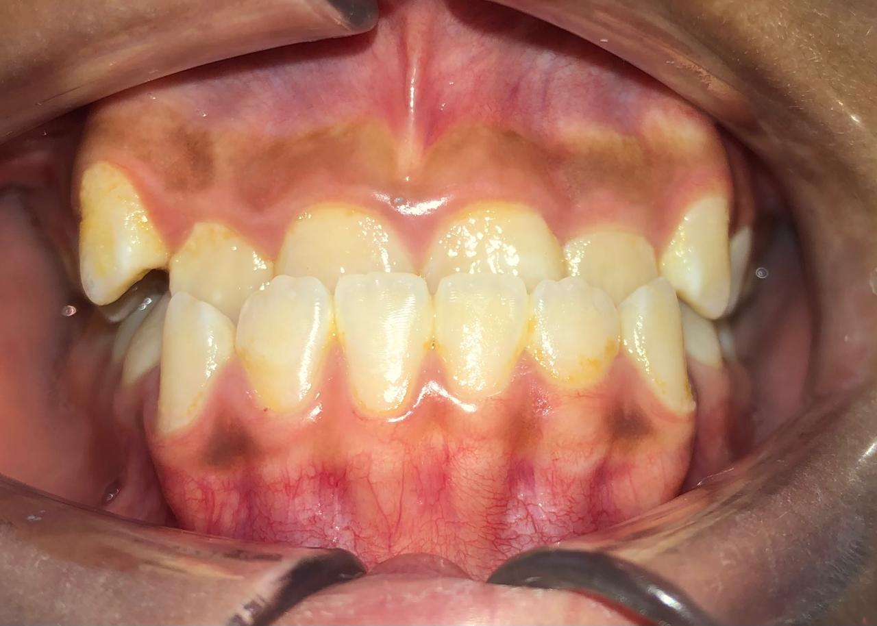 underbite