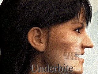 overbite
