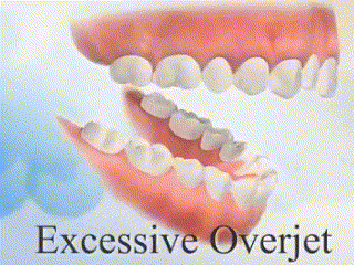overbite
