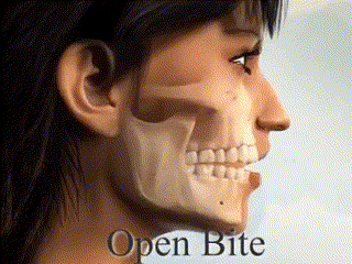 openbite
