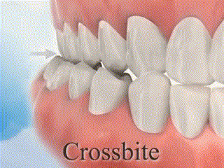 crossbite